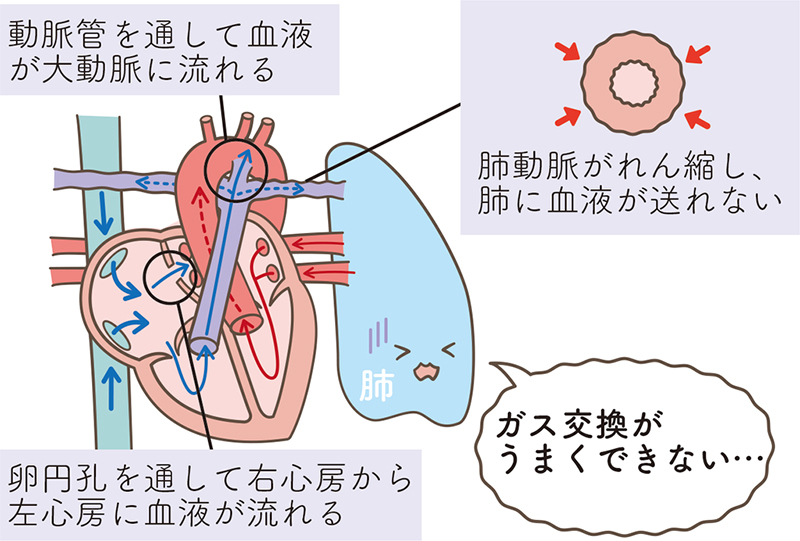 肺高血圧